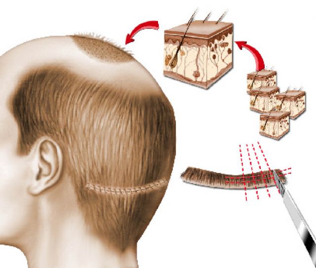 La technique de micro-greffes de cheveux longs: les 5 nouvelles